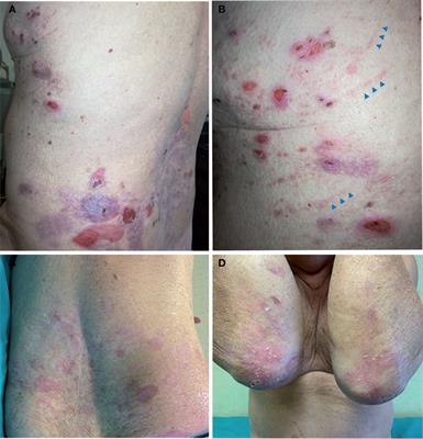 Case report: bullous pemphigoid development underlies dystrophic epidermolysis bullosa disease worsening